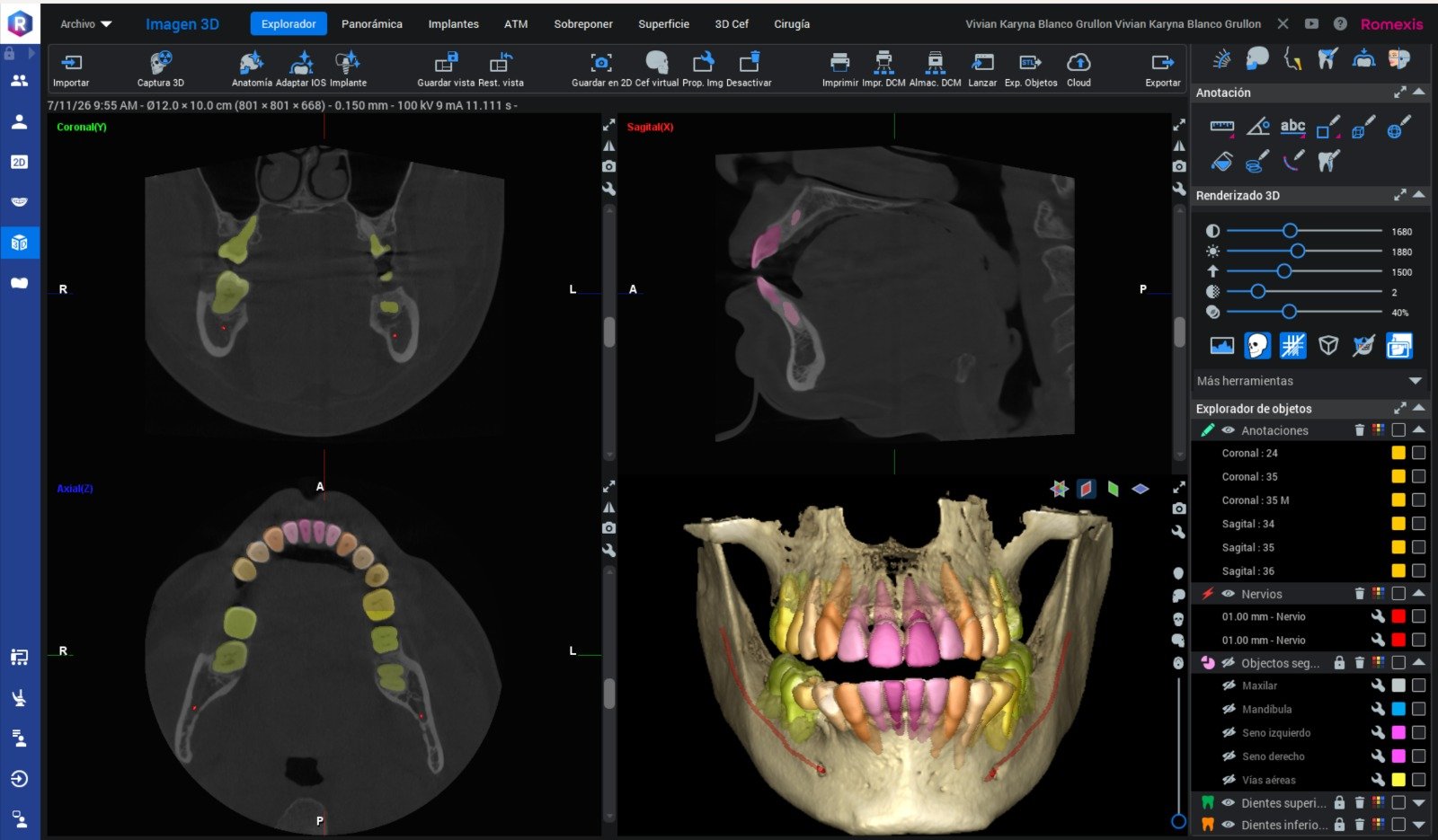 Tomografía Cone Beam - análisis 3D en Romexis